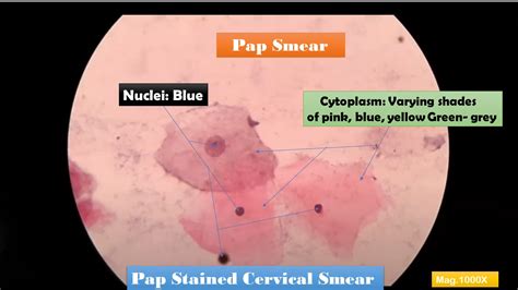 Pap Test Introduction Principle Staining Procedure Result Interpretation