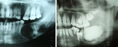 Characteristic Radiographic Features Of Ossifying Fibroma Of The Jaw