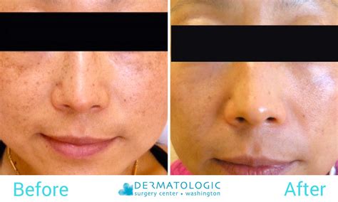 What Is Melasma And How To Treat It Dr Maral Skelsey