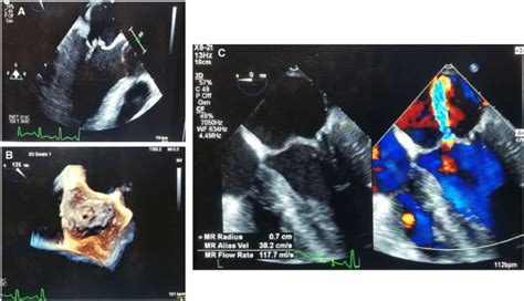 A C Tee Showing A Mitral Valve Vegetation With Perforation Of The