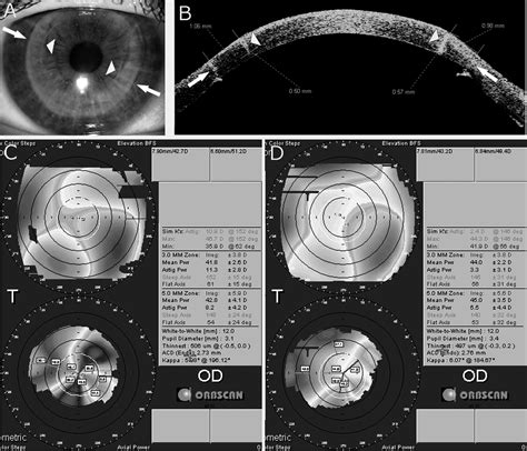 Femtosecond Laser Arcuate Keratotomy For The Correction Of High