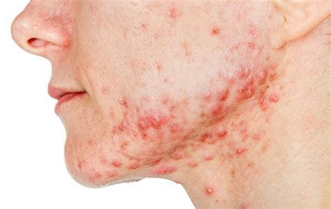What Are Different Types Of Acne Symptoms Causes And Treatment