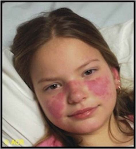 Childhood Onset Systemic Lupus Erythematosus A Review And Update The