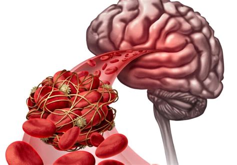 Scientists Seek Vascular Dementia Treatment By Studying Blood Flow In