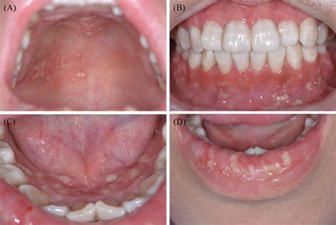 Frontiers Oral Manifestations Serve As Potential Signs Of Ulcerative