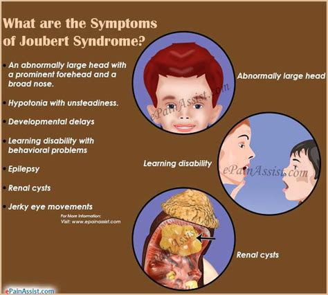 4 Kids Therapy Our Topic Today Is Joubert Syndrome