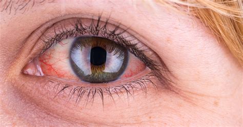 19 Causes And Treatments For Red Eyes Types Of Arthritis
