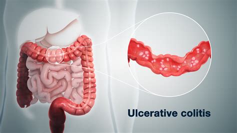Ulcerative Colitis Best Gastro Surgeon Ahmedabad Best