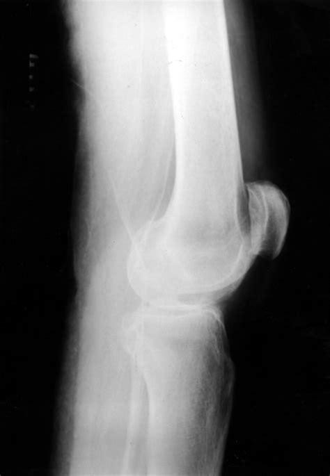 Superior Dislocation Of The Patella A Case Report And Review Of The