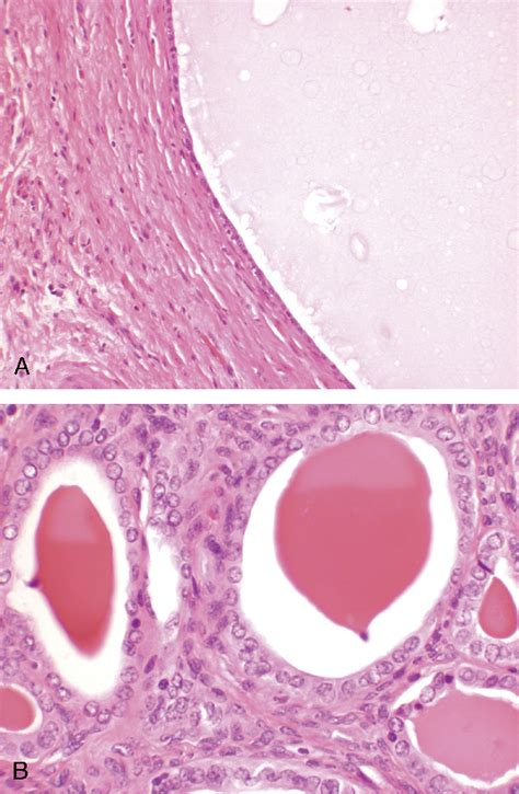 Figure 2 From Vaginal Cysts A Pathology Review Semantic Scholar