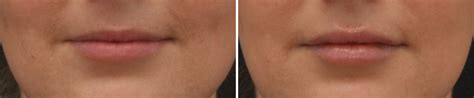 Lip Enhancement Wellesley And Boston Ma Krauss Dermatology