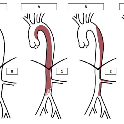 Graphical Representation Of The Proposed Aortic Dissection