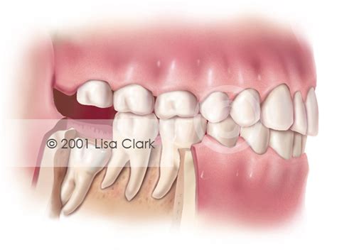 Impacted Wisdom Tooth “partial Bony” Impacted Clark Medical Illustration