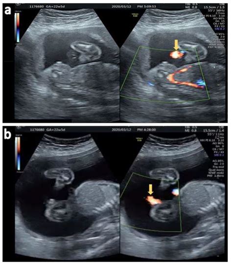 Diagnostics Free Full Text Ultrasonographic Diagnosis Of Fetal