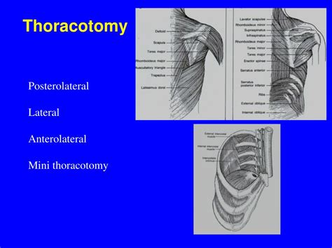 Ppt Thoracic Surgery Powerpoint Presentation Free Download Id932612