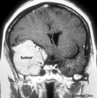 Meningiom Meningiom Cerebral Dr Tefan Mindea