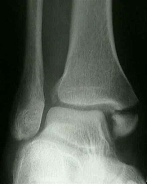 Ankle X Rays Dont Forget The Bubbles
