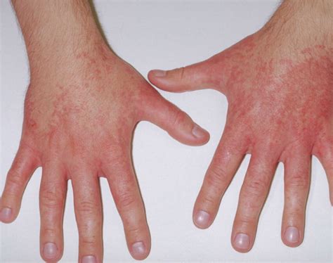 Contact Urticaria Definition Causes Symptoms Diagnosis And Prognosis