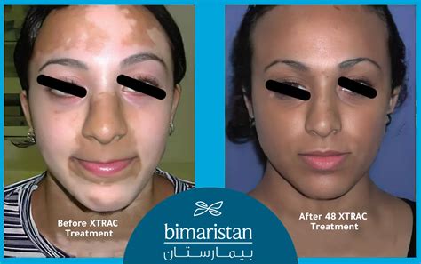 Vitiligo Laser Treatment In Türkiye The Best Choice For Removing Skin