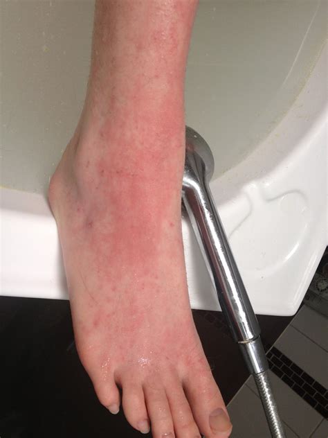 Healing Eczema And Cortisone Withdrawal Symptoms Slow Steps And