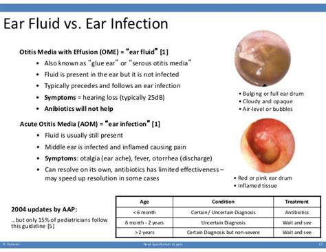 ear fluid vs ear infection otitis media with effusion ome “ear fluid” [1] … fluid in ears
