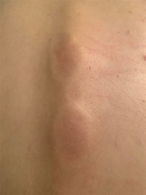 Lumps Found On Spine With Back Pain 2 Months Ago Tried Climbing A Tree