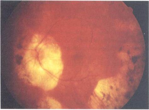 Case 2 Colour Fundus Photograph Of The Left Eye Showing Peripapillary
