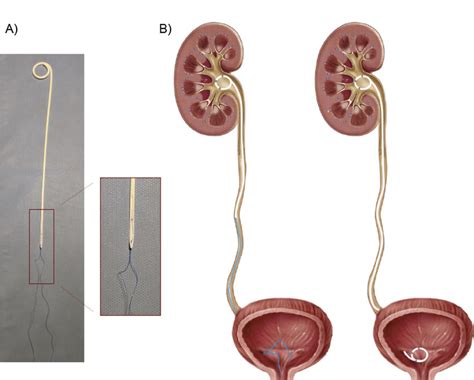 Ureteroscopy Stent