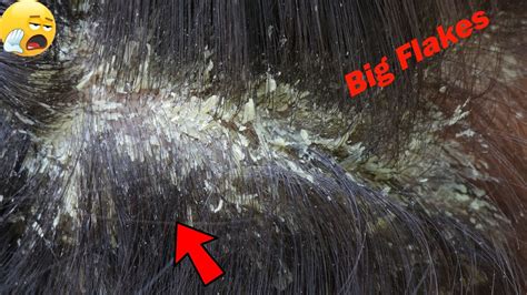 Picking Big Scalp Flakes Psoriasis On Right Side 909 Youtube