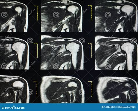 Shoulder Mri Scan Magnetic Resonance Image High Resolution Stock Photo