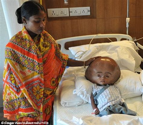 Roona Begum Whose Skull Swelled To 3 Times Its Normal Size Defies