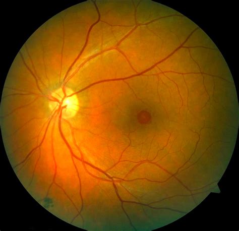 Retina Eye Jacksondop