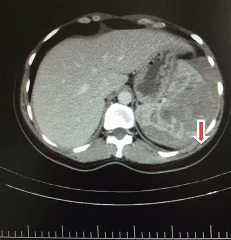 Full Text Spontaneous Splenic Rupture Without Trauma A Case Report