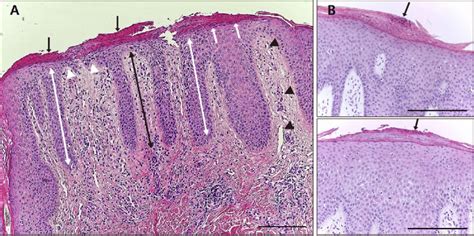 A Representative Case Of Atopic Dermatitis Showing Psoriasiform