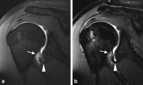 Hoàng anh gia lai f.c., an association football club. HAGL lesion. a Coronal oblique fat-suppressed T1-weight | Open-i