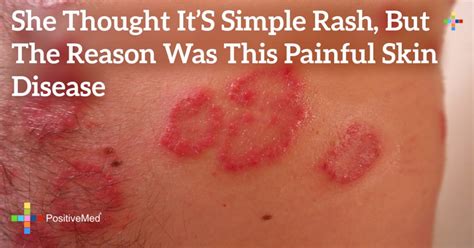 She Thought Its Simple Rash But The Reason Was This Painful Skin