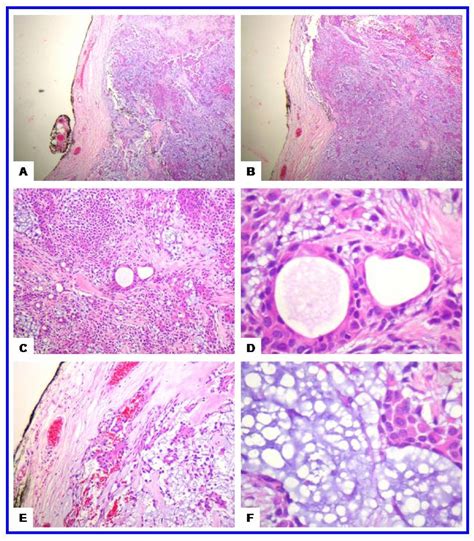Juvenile Pleomorphic Adenoma Of The Cheek A Case Report And Review Of