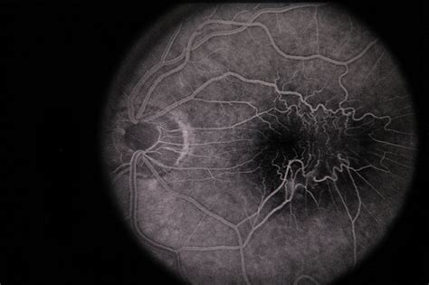 Erm Epiretinal Membrane Macular Pucker Retina Image Bank