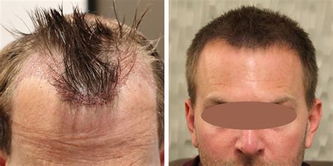 Hair Restoration Before After Photos Modena Hair Institute