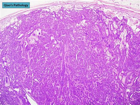 Qiao S Pathology Basal Cell Adenoma Of The Parotid Gland A Photo On