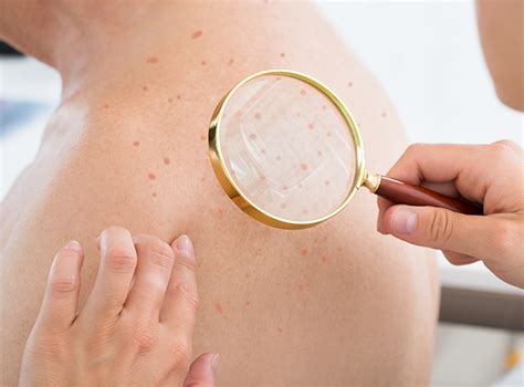 Walk In Dermatology Full Body Skin Exams Why A Regular Screening Is So Important