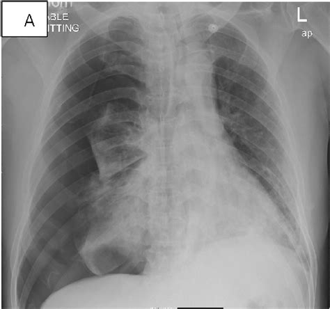 A Large Right Sided Pneumothorax With Mediastinal Shift Towards Left