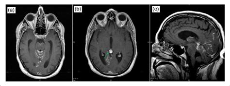 A And B Axial T1 Post Contrast Gadolinium Mri Of The Brain Which