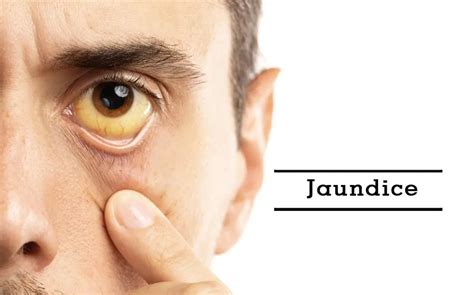 Jaundice Symptoms Causes Diagnosis And Treatment Max Lab