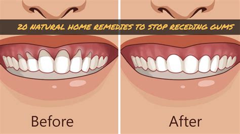 20 Natural Home Remedies To Stop Receding Gums Wellnessguide