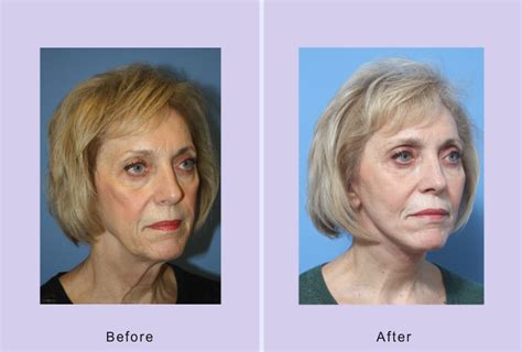 This Patient Underwent A 3 D Facelift A Combination Of A Lower