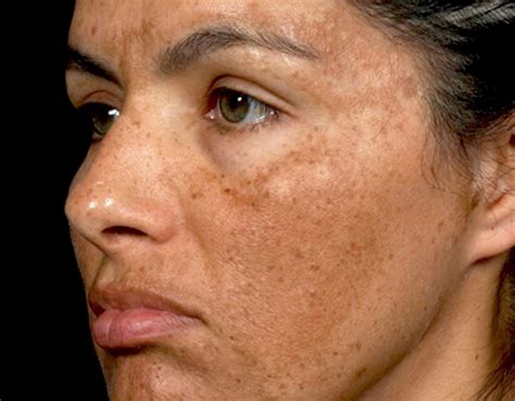 Cómo Quitar Las Manchas De La Cara Dra Jennifer Granizo Dermatóloga