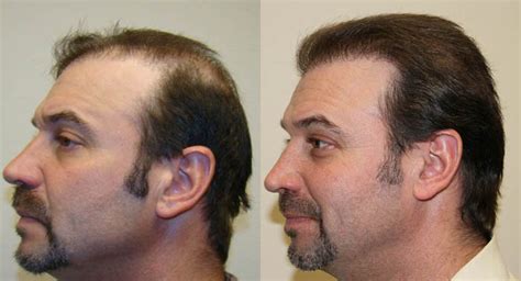 Hair Transplant Before And After