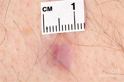 Skin Cancer Photograph By Medical Photo Nhs Lothianscience Photo Library