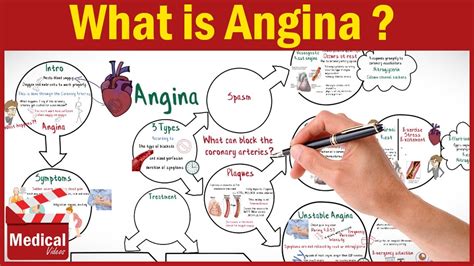 Angina Concept Map
